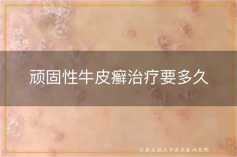 顽固性牛皮癣治疗要多久