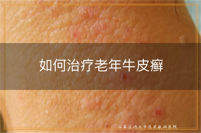 如何治疗老年牛皮癣