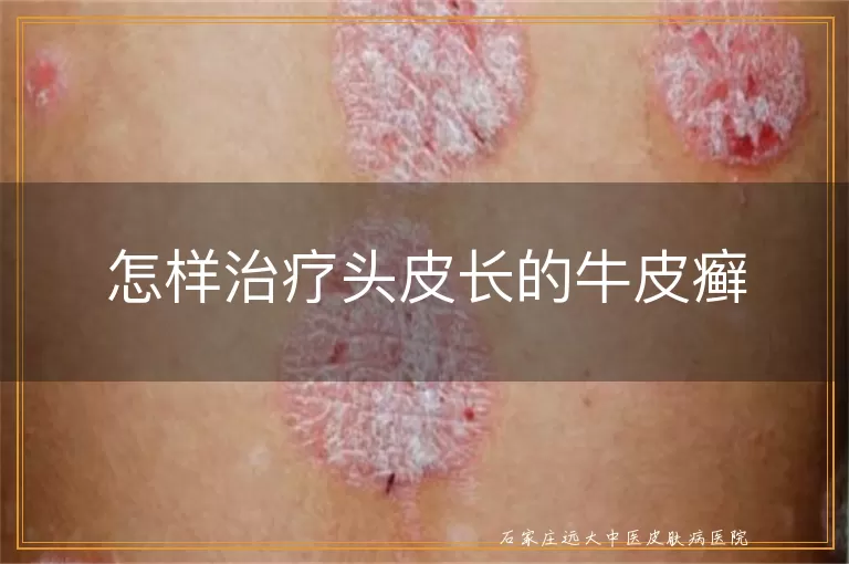 怎样治疗头皮长的牛皮癣