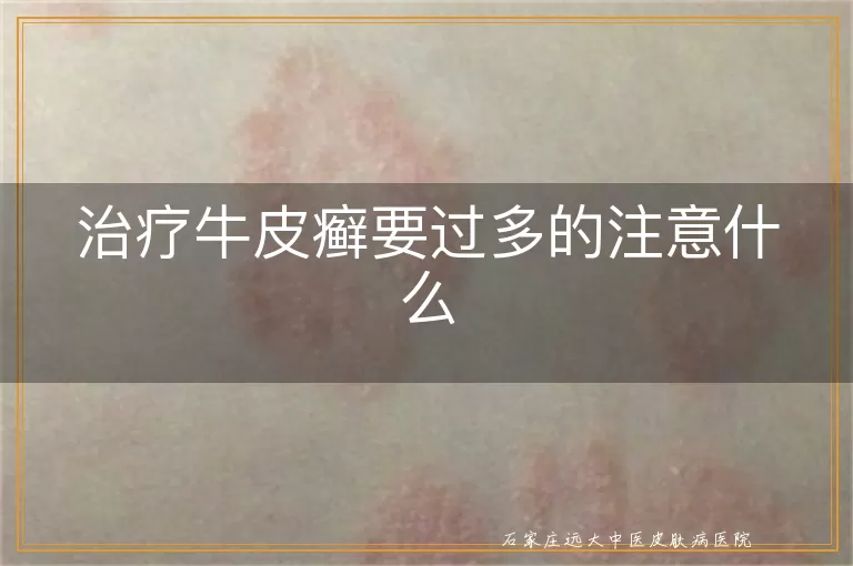 治疗牛皮癣要过多的注意什么