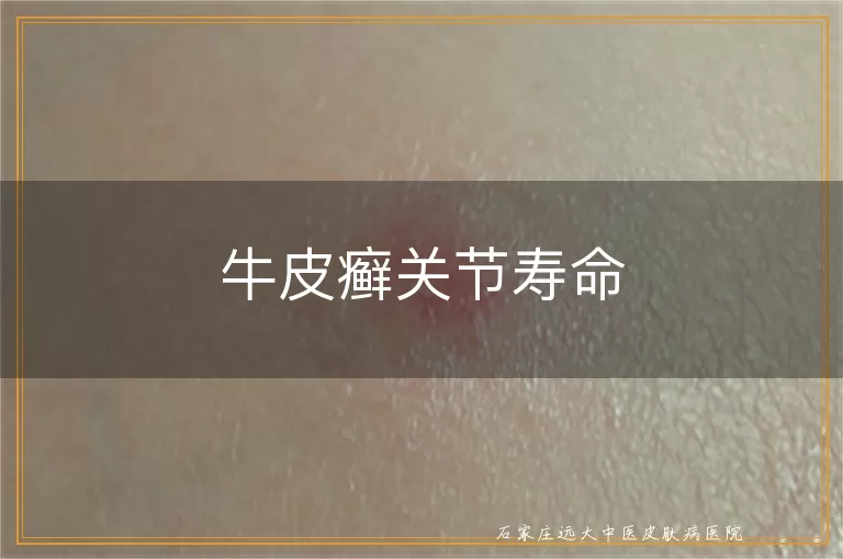 牛皮癣关节寿命
