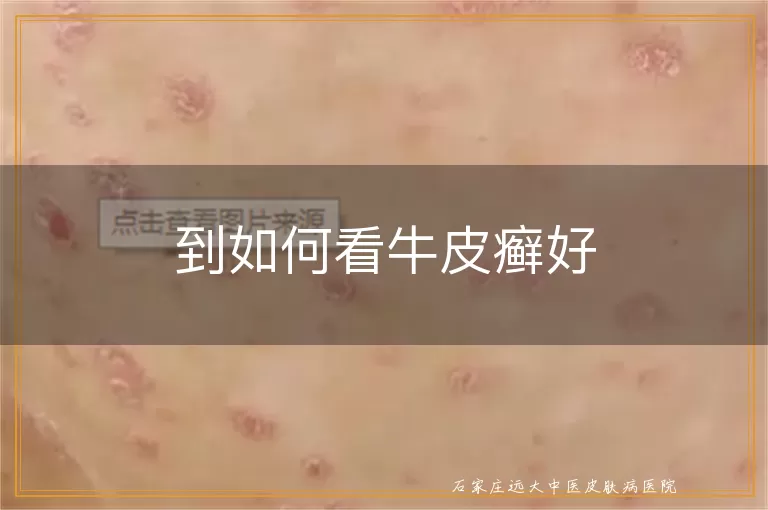 到如何看牛皮癣好