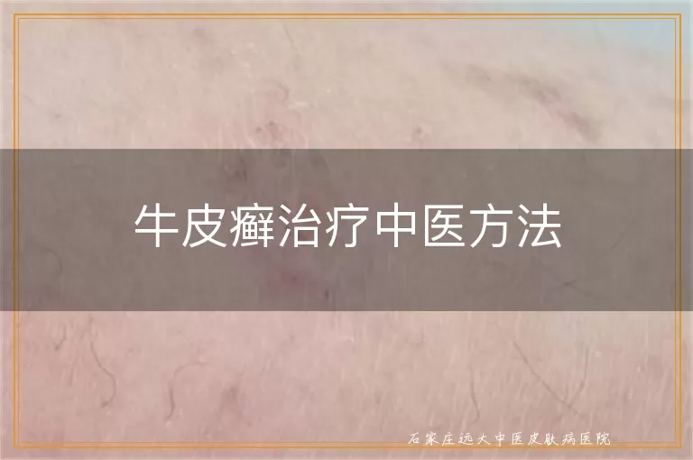 牛皮癣治疗中医方法