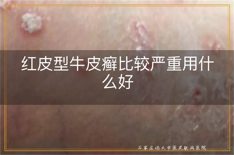 红皮型牛皮癣比较严重用什么好