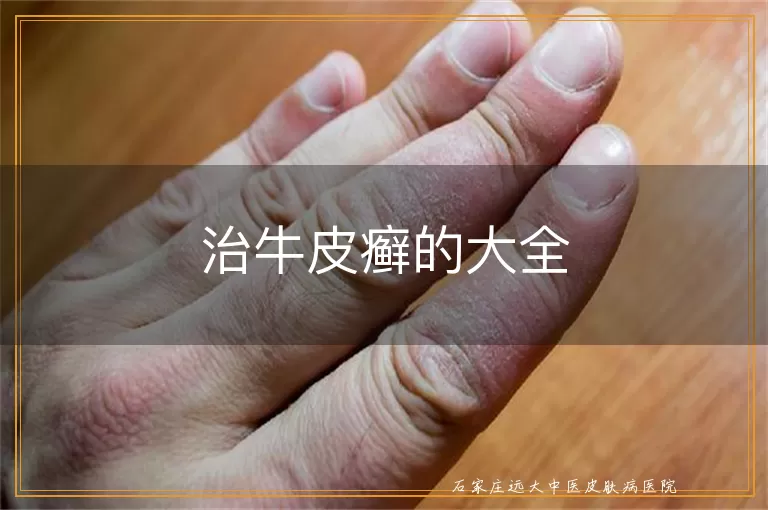 治牛皮癣的大全