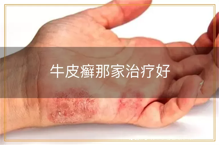 牛皮癣那家治疗好