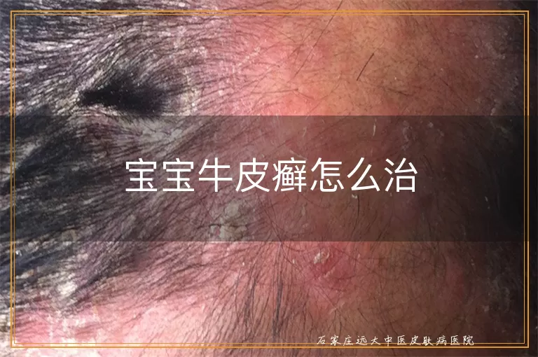 宝宝牛皮癣怎么治