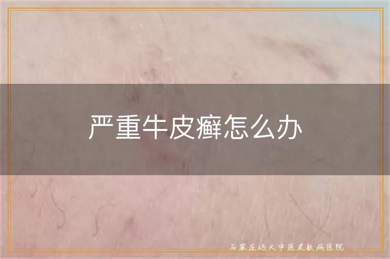 严重牛皮癣怎么办
