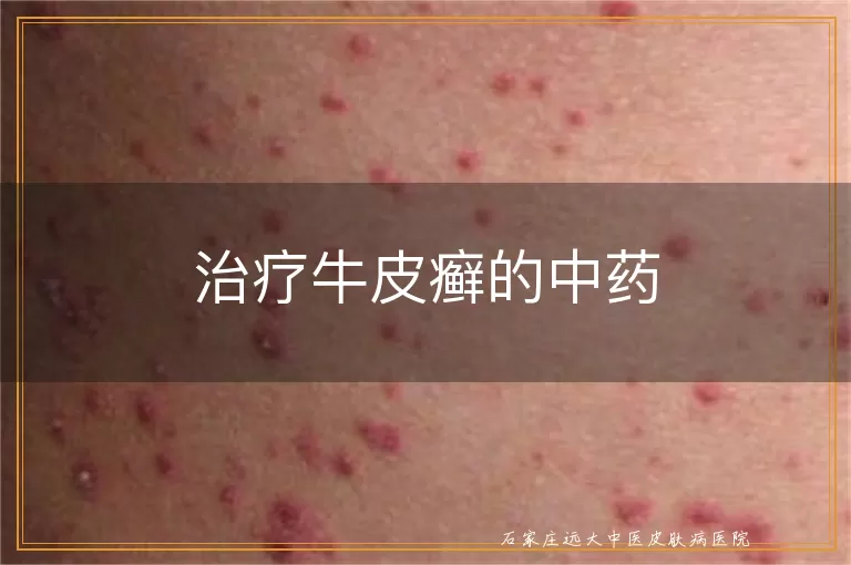 治疗牛皮癣的中药