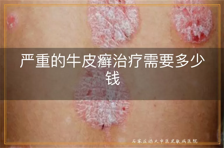 严重的牛皮癣治疗需要多少钱