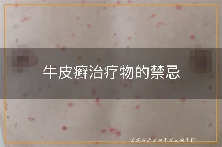 牛皮癣治疗物的禁忌