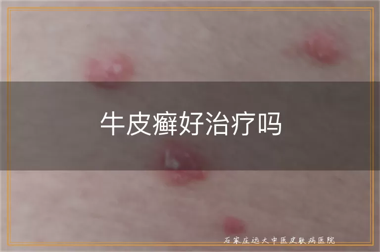 牛皮癣好治疗吗