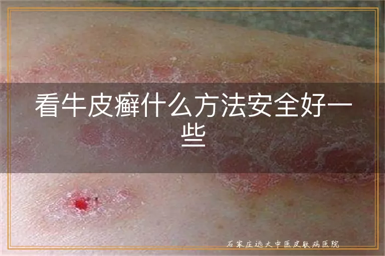 看牛皮癣什么方法安全好一些