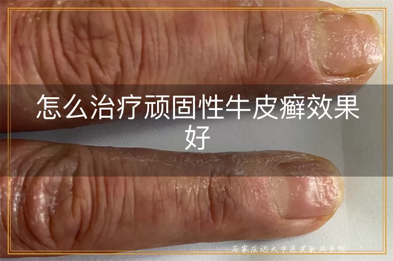 怎么治疗顽固性牛皮癣效果好