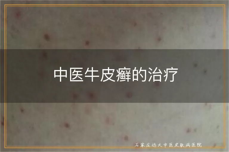 中医牛皮癣的治疗