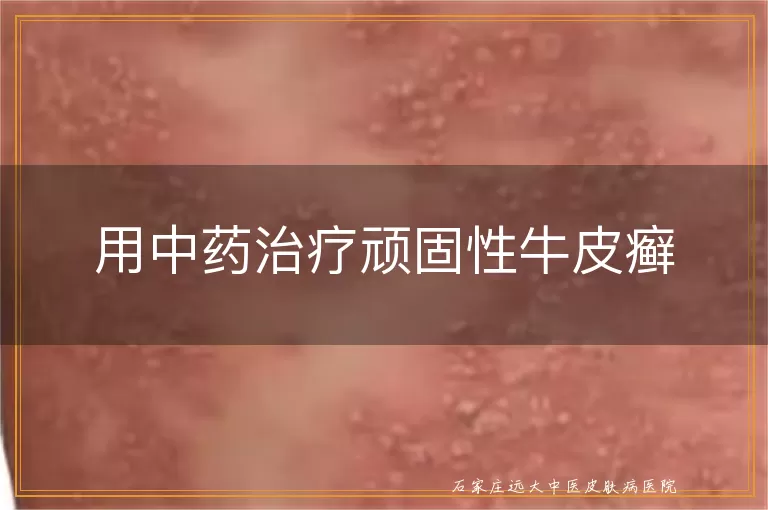 用中药治疗顽固性牛皮癣