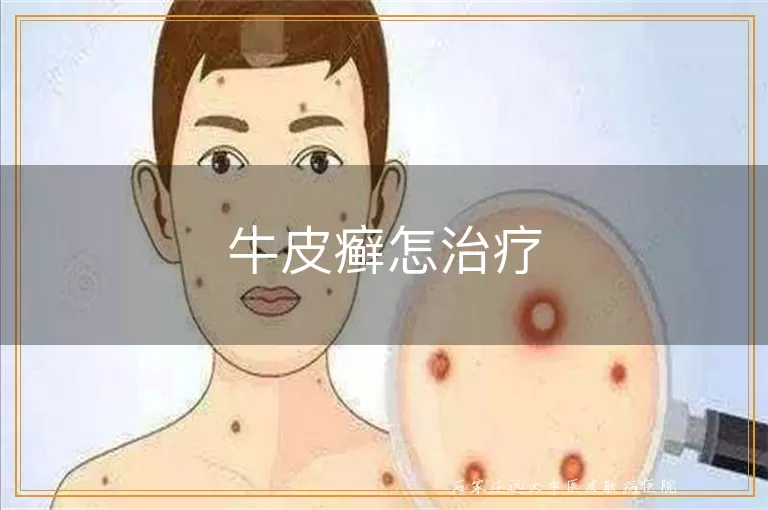 牛皮癣怎治疗