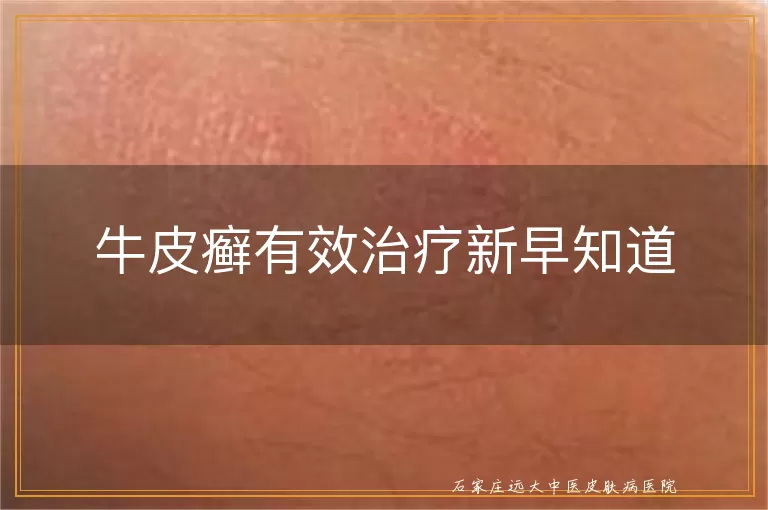 牛皮癣有效治疗新早知道