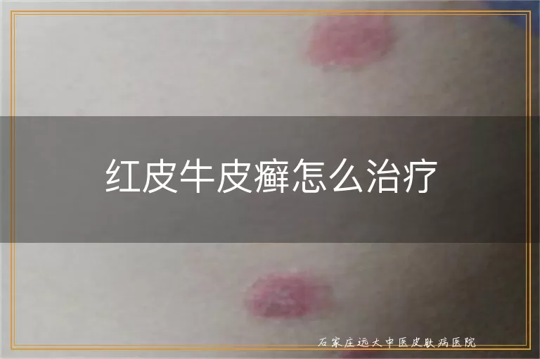 红皮牛皮癣怎么治疗