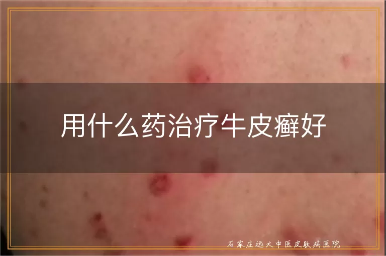 用什么药治疗牛皮癣好