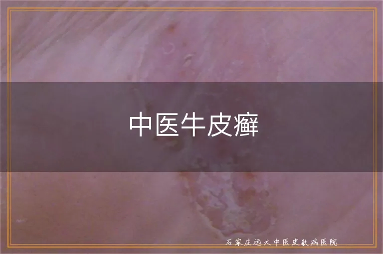 中医牛皮癣