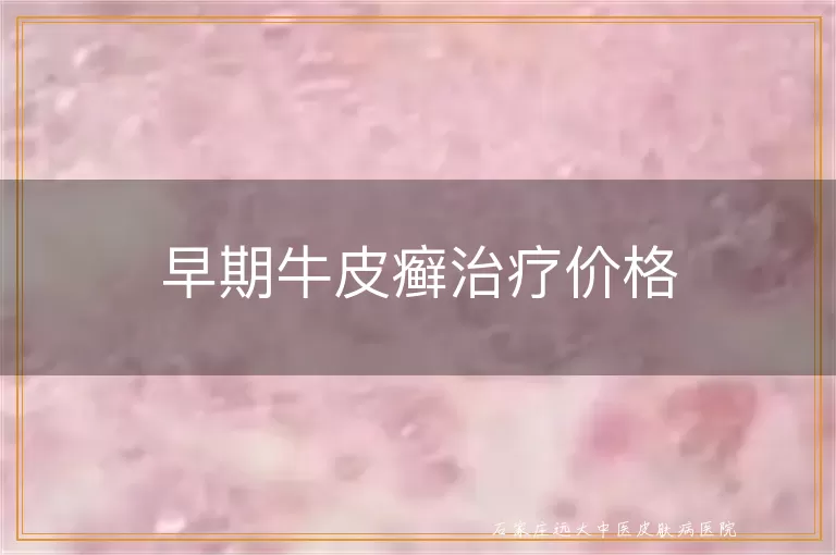 早期牛皮癣治疗价格