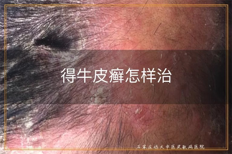 得牛皮癣怎样治