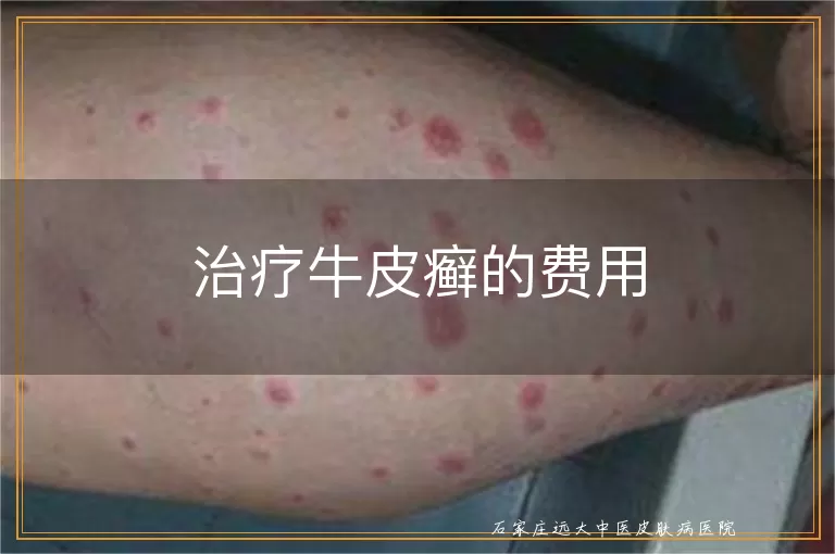 治疗牛皮癣的费用