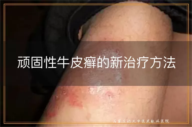 顽固性牛皮癣的新治疗方法