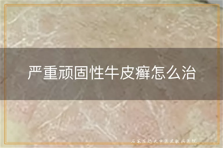 严重顽固性牛皮癣怎么治