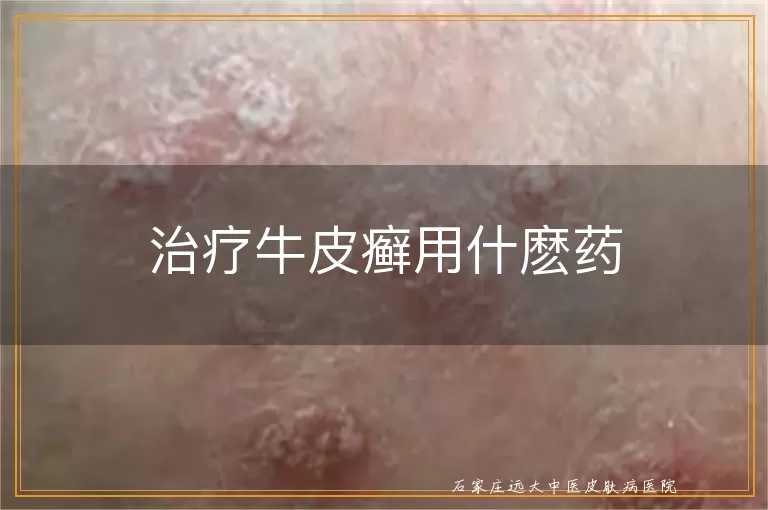 治疗牛皮癣用什麽药