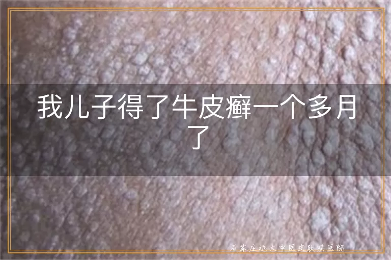 我儿子得了牛皮癣一个多月了