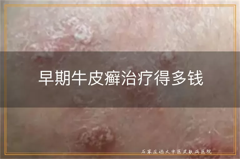 早期牛皮癣治疗得多钱