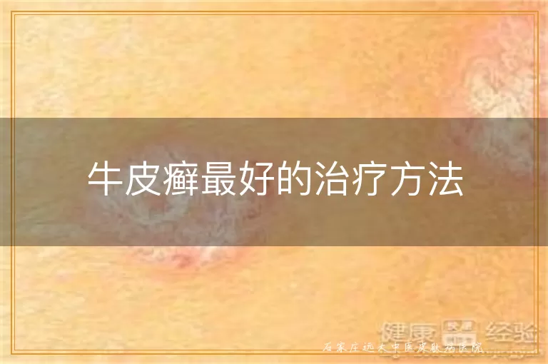 牛皮癣最好的治疗方法