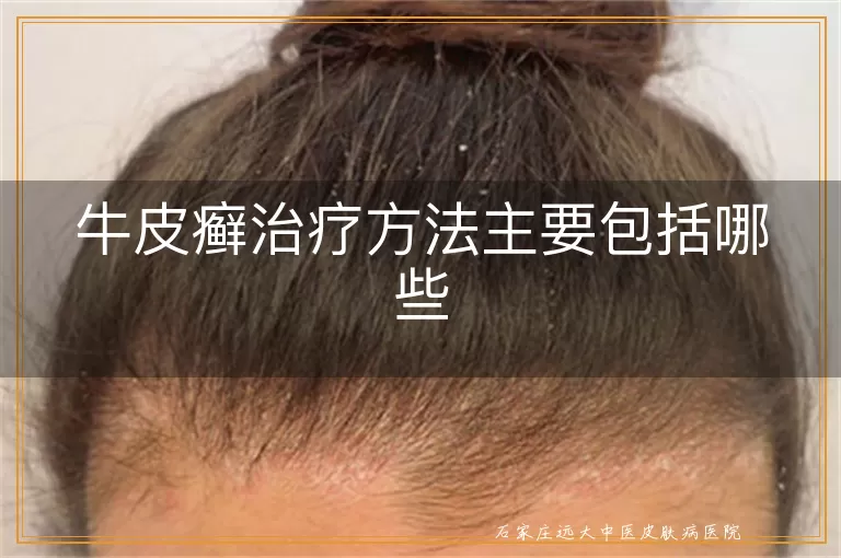 牛皮癣治疗方法主要包括哪些