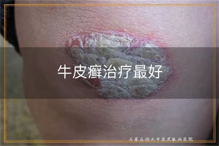 牛皮癣治疗最好