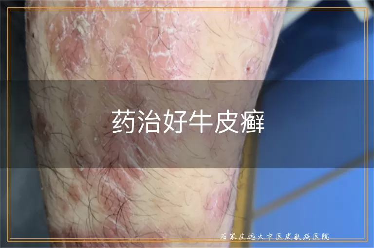 药治好牛皮癣