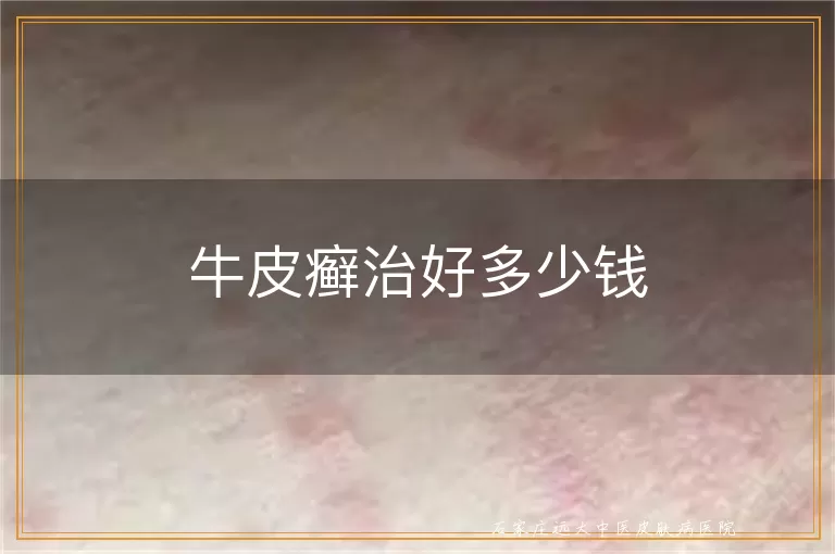 牛皮癣治好多少钱