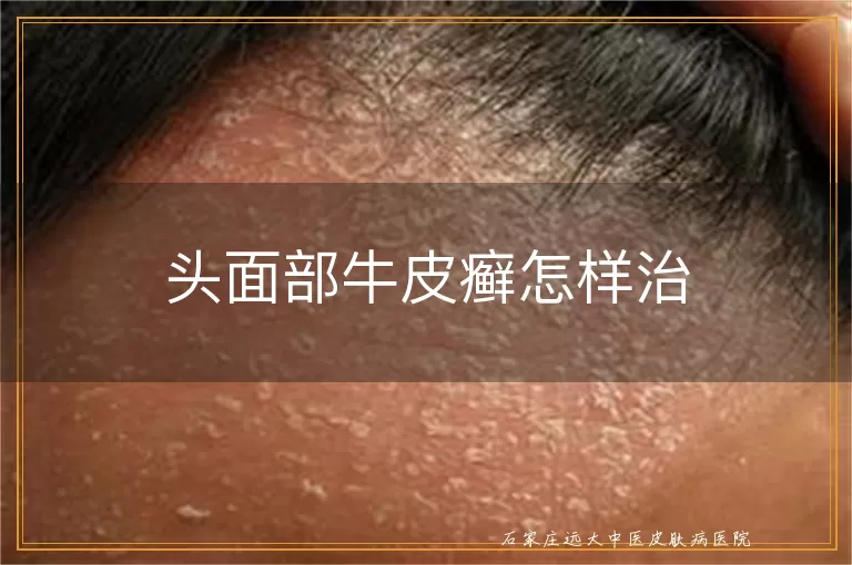 头面部牛皮癣怎样治