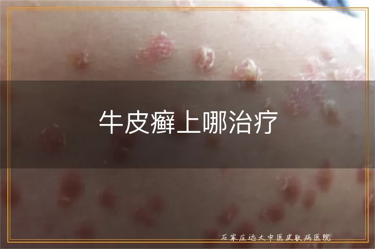 牛皮癣上哪治疗