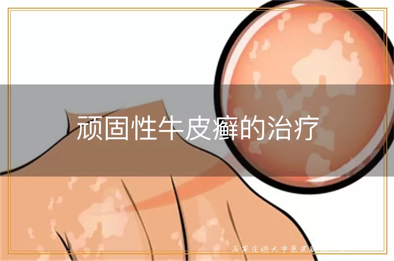 顽固性牛皮癣的治疗