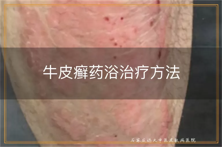 牛皮癣药浴治疗方法