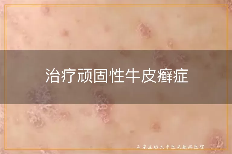 治疗顽固性牛皮癣症