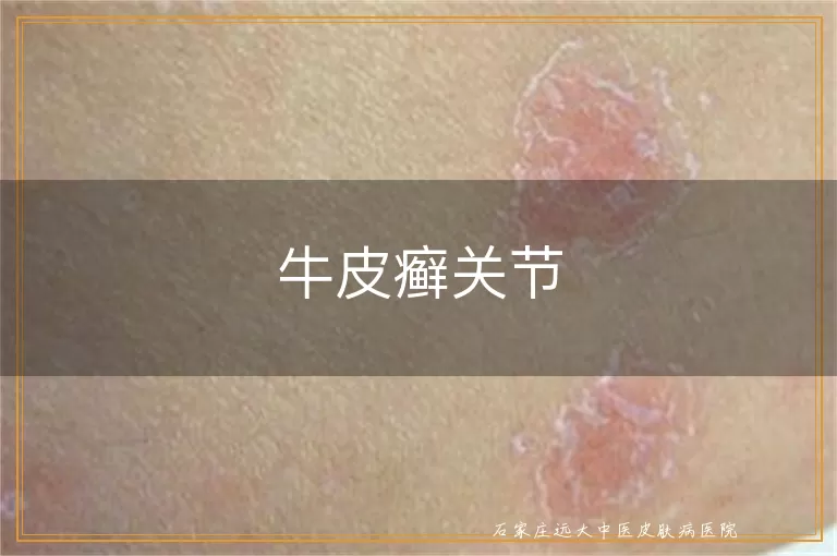 牛皮癣关节