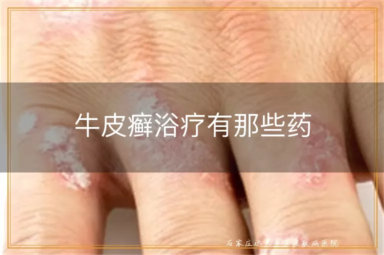 牛皮癣浴疗有那些药
