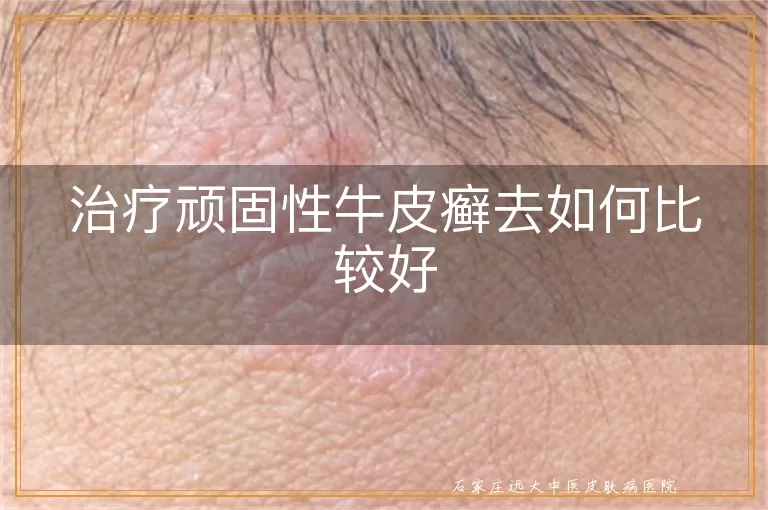 治疗顽固性牛皮癣去如何比较好