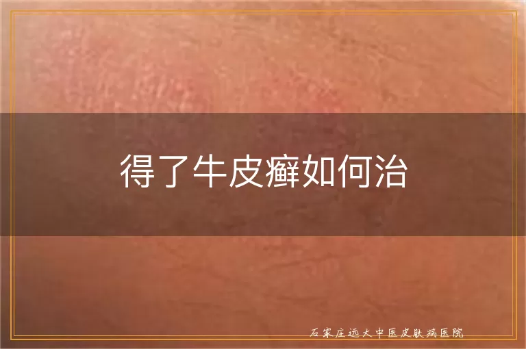得了牛皮癣如何治