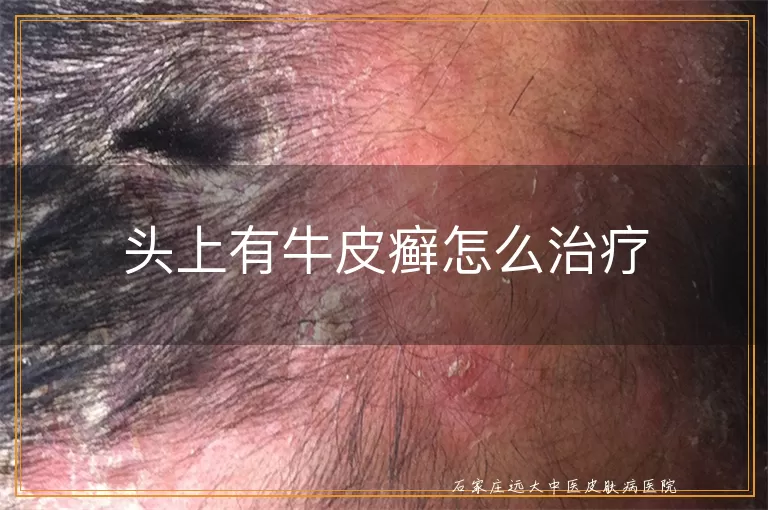 头上有牛皮癣怎么治疗