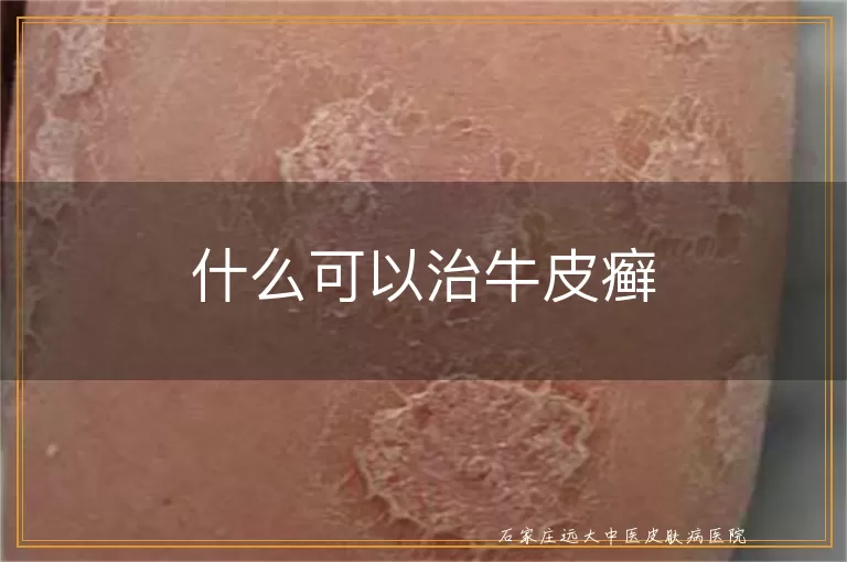 什么可以治牛皮癣