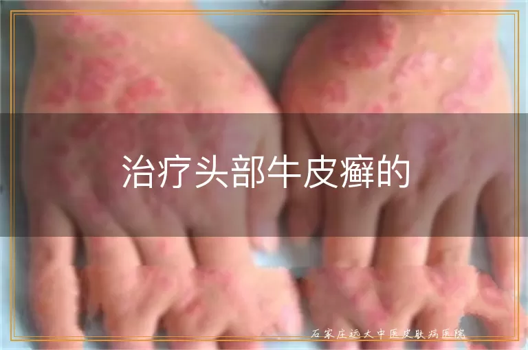 治疗头部牛皮癣的
